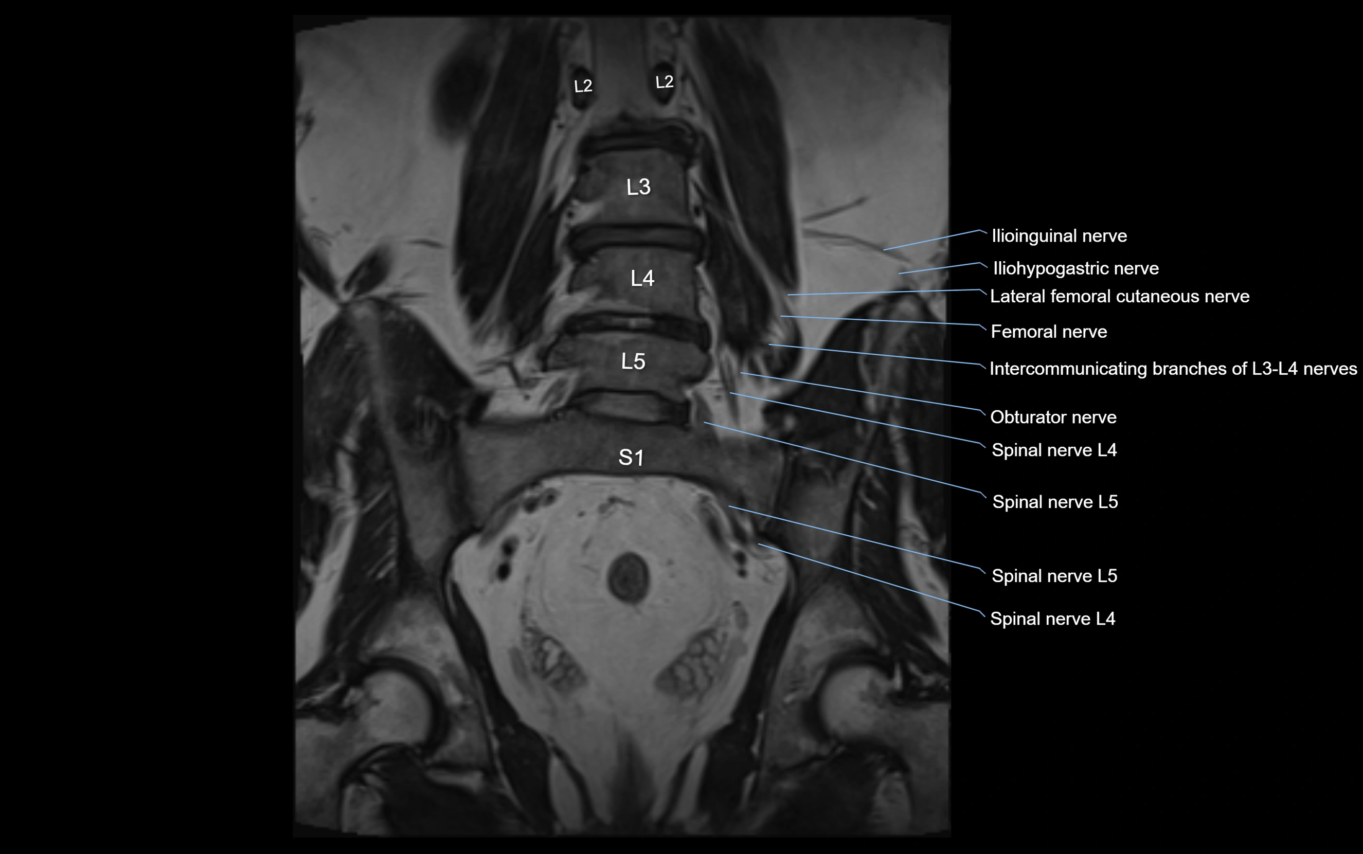 MR lumbosacral plexus cross sectional anatomy 3T  radiology  image-img-09001-00035.webp